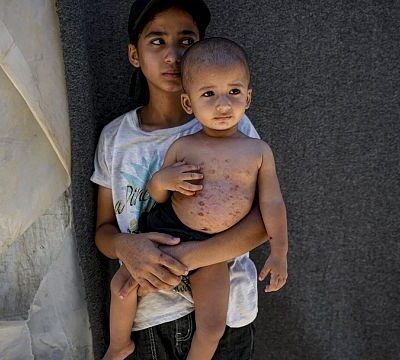 Gaza war: Skin diseases spread among children in overcrowded camps
