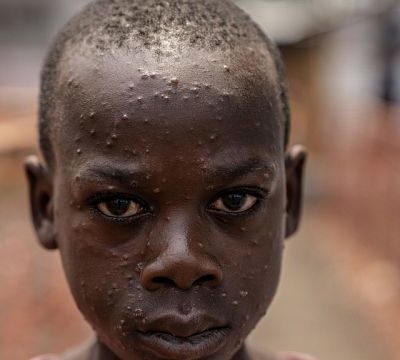 WHO and Africa CDC launch response plan to the mpox outbreak