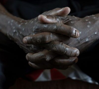 Mpox case found in Uganda prison, official says