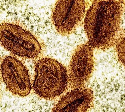 Mpox outbreak no longer a global health emergency, WHO chief says