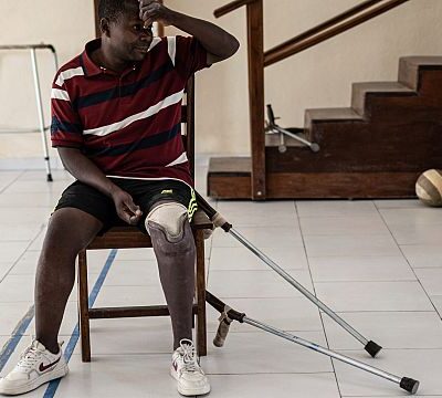 Amid escalating violence in Eastern Congo, demand for prosthetics soars