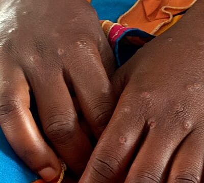 WHO reports rapid spread of Mpox with 17 deaths in Africa over recent weeks